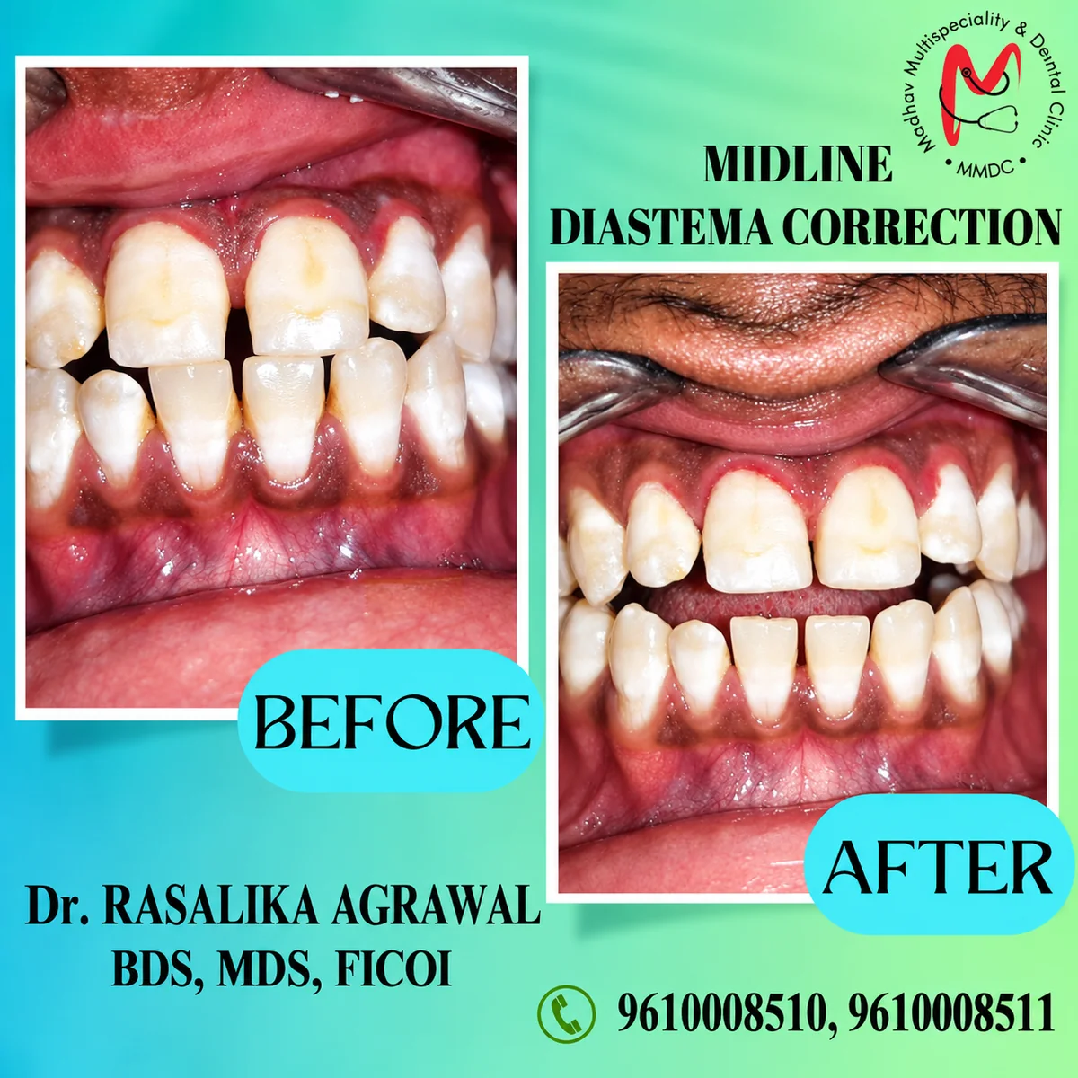 Midline diastema gap closure before and after