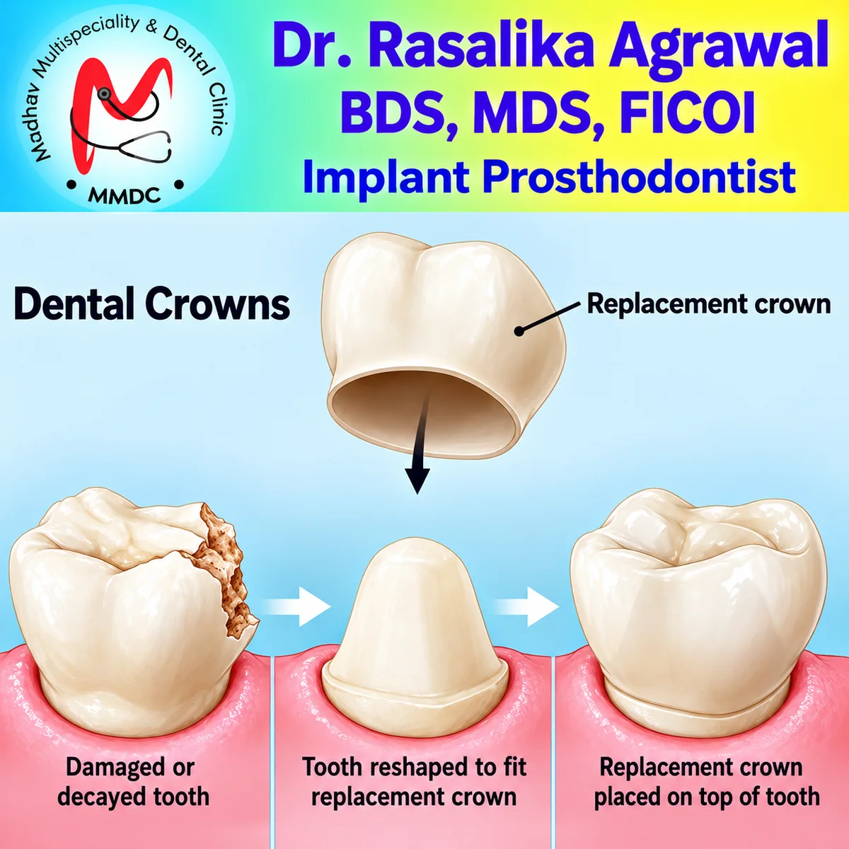 Dental crown replacement procedure visual guide
